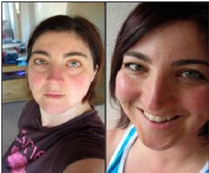 Health issues due to gluten