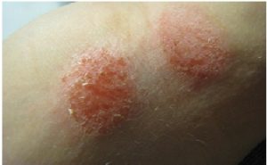 Health issues due to gluten