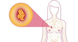 Top 10,Warning Signs,Breast Cancer,Symptoms