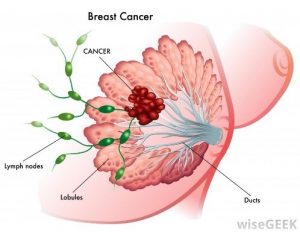 Top 10,Warning Signs,Breast Cancer,Symptoms